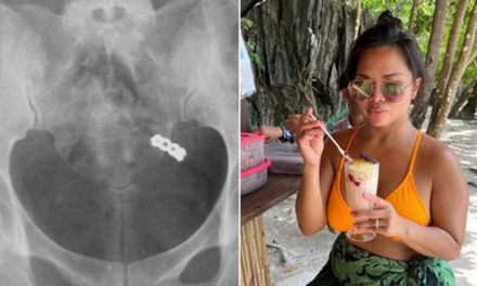 Woman accidentally swallows wedding ring while taking vitamins, X-ray shows