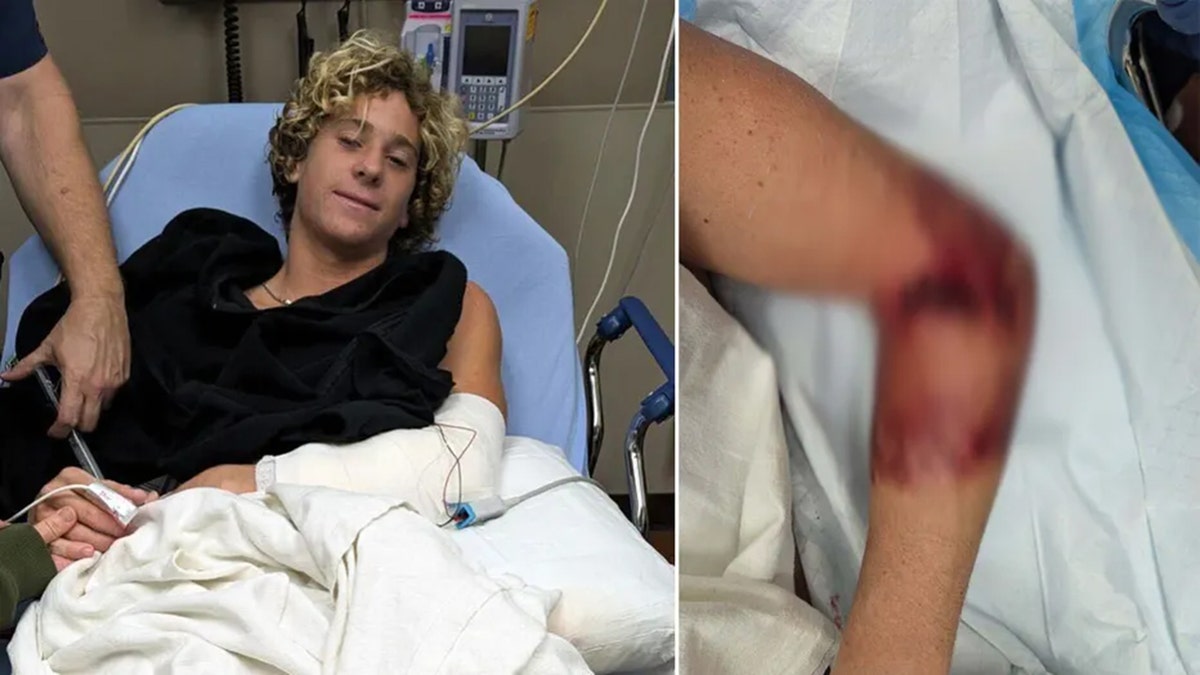 Florida teen surfer bitten by shark