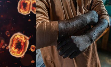 First known case of rare mpox strain confirmed in United States