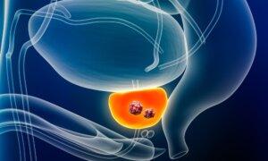 Prostate Cancer Treatments Carry Substantial Long-Term Risks: Study